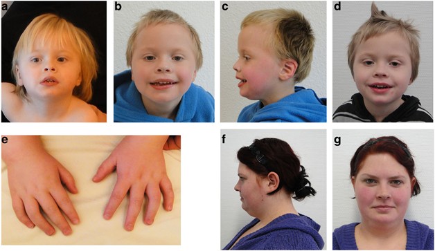 A mosaic maternal splice donor mutation in the EHMT1 gene leads to aberrant  transcripts and to Kleefstra syndrome in the offspring