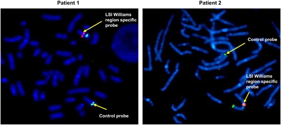 PDF) Identification of de novo EP300 and PLAU variants in a patient with  Rubinstein–Taybi syndrome-related arterial vasculopathy and skeletal anomaly