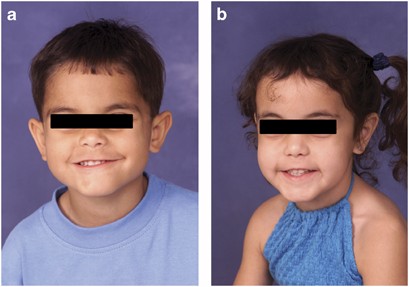 Identification of de novo EP300 and PLAU variants in a patient with  Rubinstein–Taybi syndrome-related arterial vasculopathy and skeletal  anomaly
