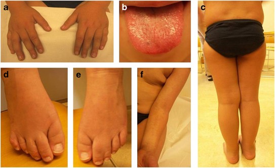Germline Ptpn11 And Somatic Pik3ca Variant In A Boy With Megalencephaly Capillary Malformation Syndrome Mcap Pure Coincidence European Journal Of Human Genetics