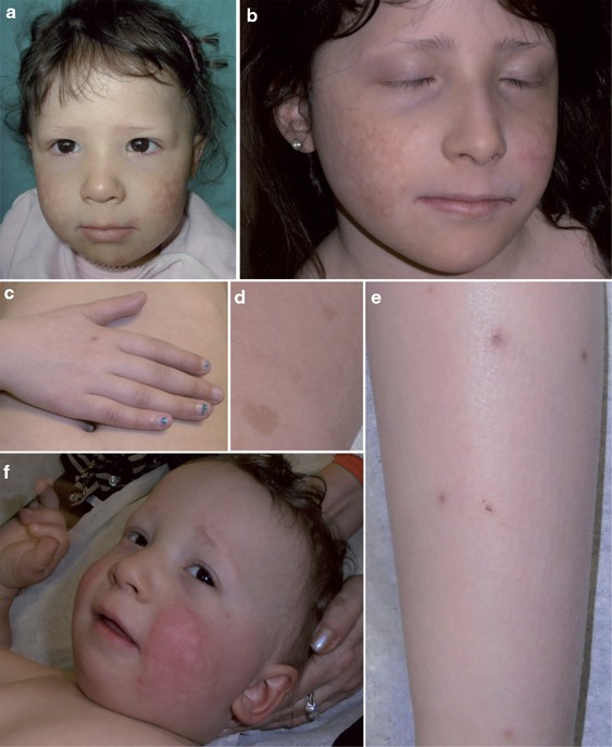 PDF) Identification of de novo EP300 and PLAU variants in a patient with Rubinstein–Taybi syndrome-related arterial vasculopathy and skeletal anomaly