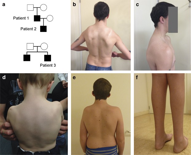 Prominent scapulae mimicking an inherited myopathy expands the phenotype of  CHD7-related disease | European Journal of Human Genetics