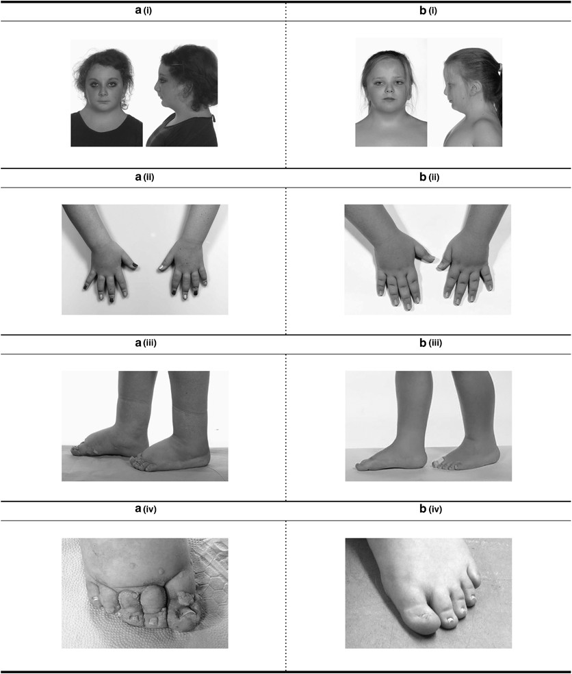 The lymphatic phenotype in Turner syndrome: an evaluation of nineteen  patients and literature review | European Journal of Human Genetics