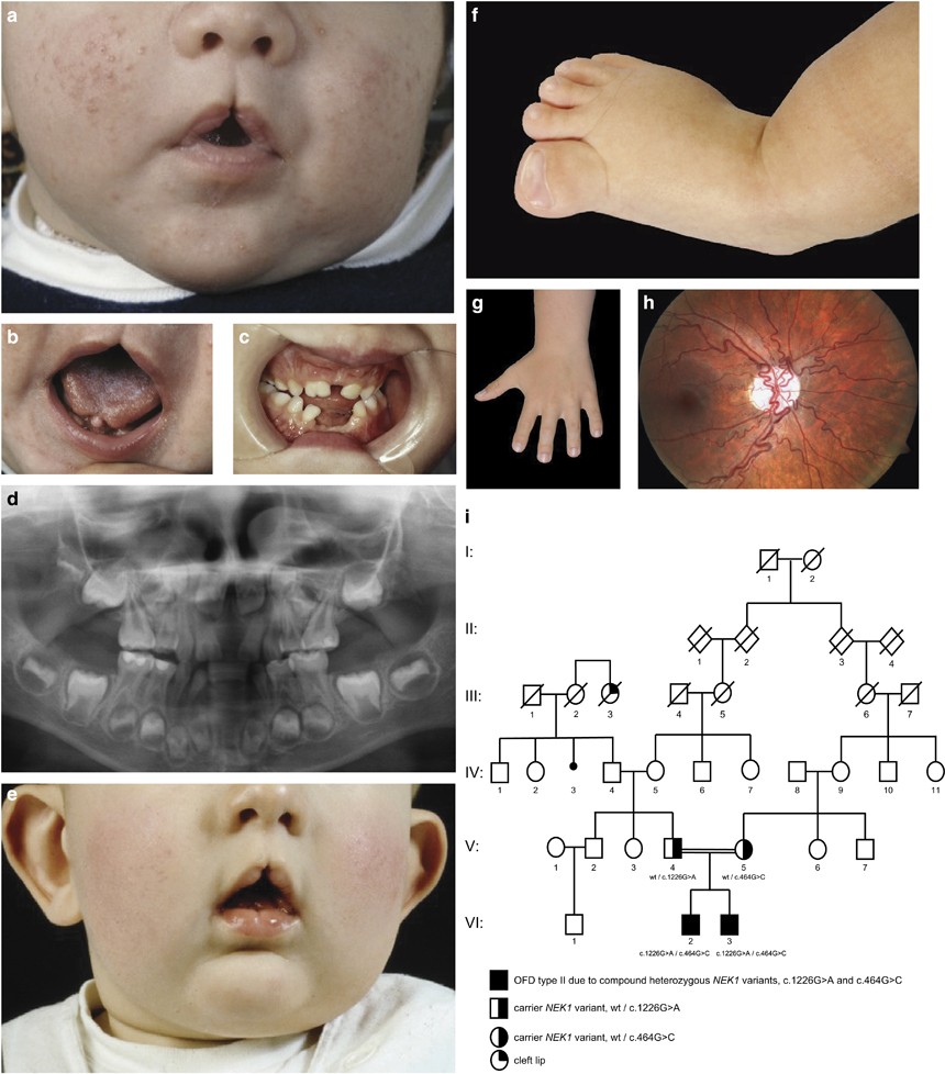 Compound Heterozygous Nek1 Variants In Two Siblings With Oral Facial Digital Syndrome Type Ii Mohr Syndrome European Journal Of Human Genetics