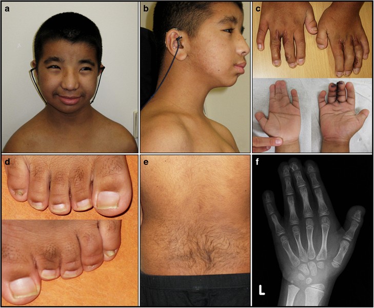 Rubinstein-Taybi syndrome: A report of two siblings with