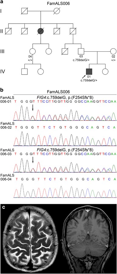 Fig4 Variants In Central European Patients With Amyotrophic Lateral Sclerosis A Whole Exome And Targeted Sequencing Study European Journal Of Human Genetics