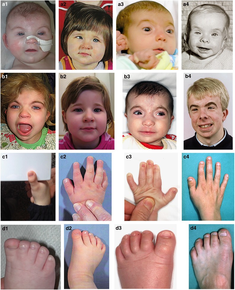 Facial features of Rubinstein-Taybi syndrome