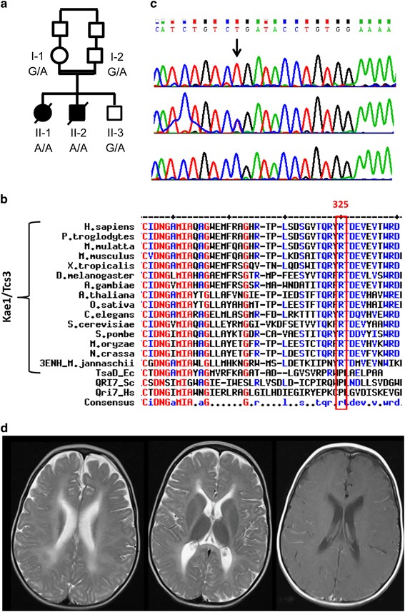 N6-adenosine threonylcarbamoyltransferase defect due to KAE1/TCS3 (OSGEP) mutation manifest by neurodegeneration and renal tubulopathy European Journal of Human Genetics