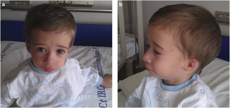 Mcm5 A New Actor In The Link Between Dna Replication And Meier Gorlin Syndrome European Journal Of Human Genetics
