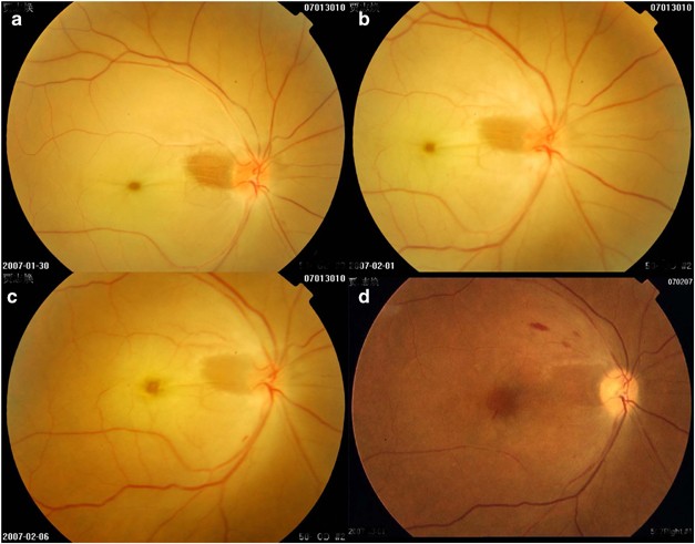central retinal artery occlusion vs normal