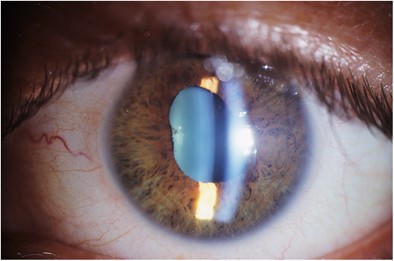 Ocular complications of laser-assisted eyebrow epilation | Eye