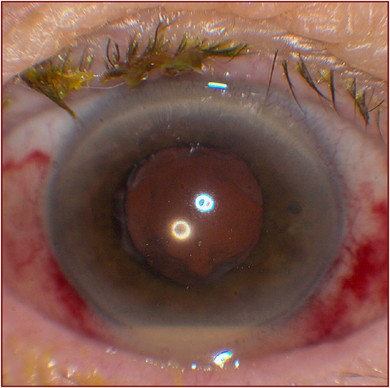 Postoperative endophthalmitis: optimal management and the role and timing  of vitrectomy surgery | Eye