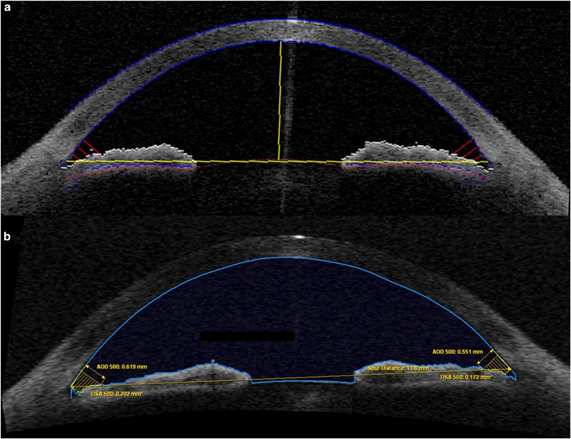 Comparison of Visante and slit-lamp anterior segment optical coherence  tomography in imaging the anterior chamber angle | Eye