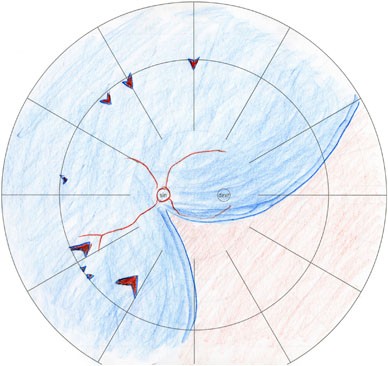A Novel Technique For Removal Of Inadvertent Subretinal Perfluorocarbon Liquid After Complex Retinal Detachment Surgery Eye