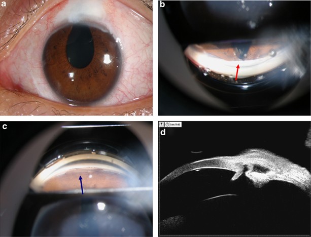 Recurrent iris prolapse after laser goniopuncture in an open-angle glaucoma  patient treated with non-penetrating trabecular surgery | Eye