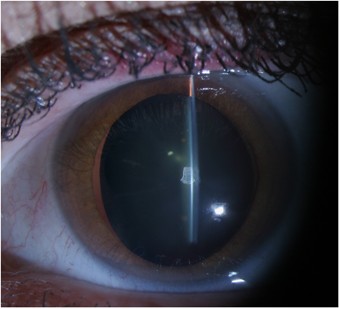 Angle closure glaucoma associated with ectopia lentis in a patient with  Sturge-Weber syndrome | Eye