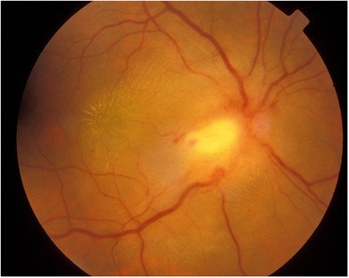 Retina atrófia