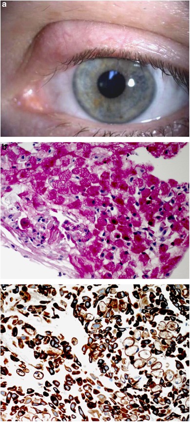 Primary signet ring cell carcinoma of the eyelid in a young woman | Eye