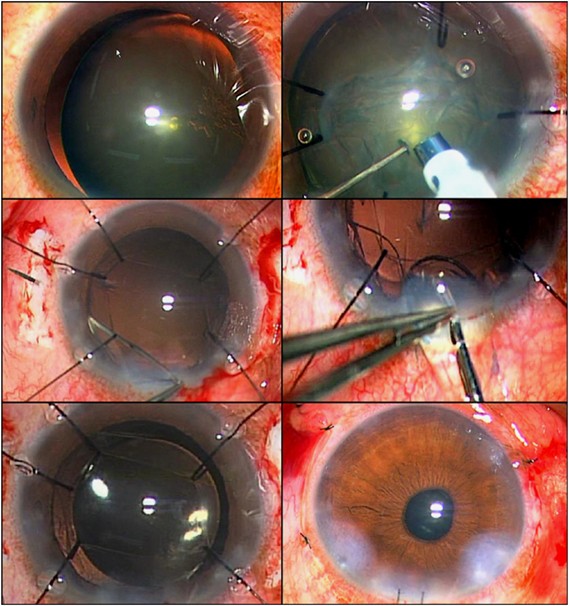 In-the-bag scleral suturing of intraocular lens in eyes with severe zonular  dehiscence | Eye
