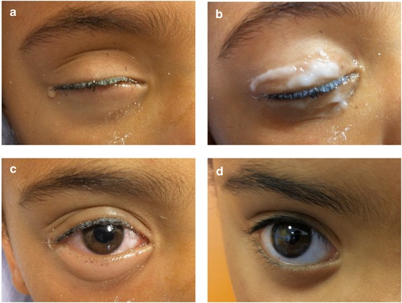 Eyelid anaesthesia using tetracaine gel in the treatment of paediatric superglue tarsorrhaphy Eye