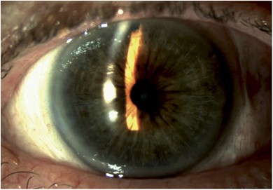 Phacoemulsification with therapeutic implantation of a prosthetic iris  device following peripheral iridotomy visual complication | Eye