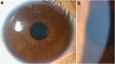 In Vivo Confocal Microscopy Of The Cornea In Morquio - 
