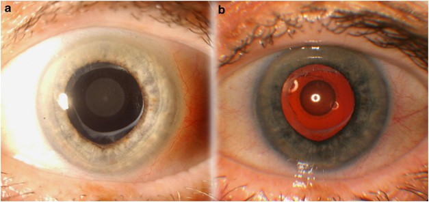 Intraocular lens opacification mimicking the appearance of a congenital  lamellar cataract | Eye