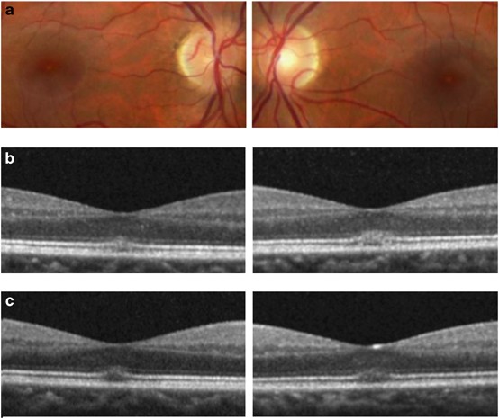 Adverse ophthalmic reaction in poppers users: case series of 'poppers  maculopathy' | Eye