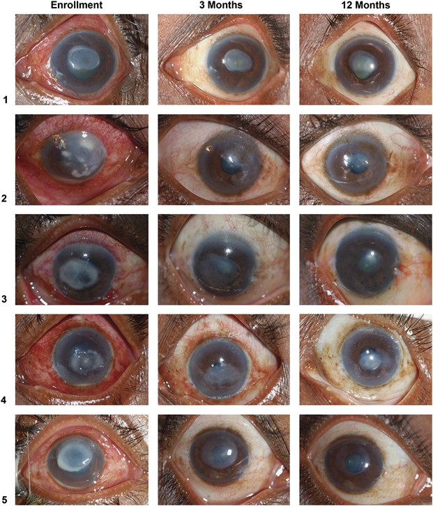 Improvement in corneal scarring following bacterial keratitis | Eye