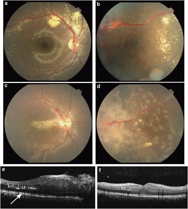 Vitrectomy for epiretinal membrane secondary to treatment for juvenile Coats'  disease | Eye