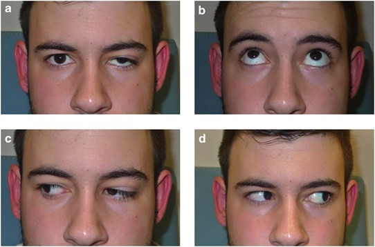 Congenital ptosis associated with combined superior rectus, lateral rectus,  and levator palpebrae synkinesis: the first reported case | Eye
