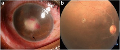 Traumatic endophthalmitis caused by Shewanella putrefaciens associated with  an open globe fishhook injury