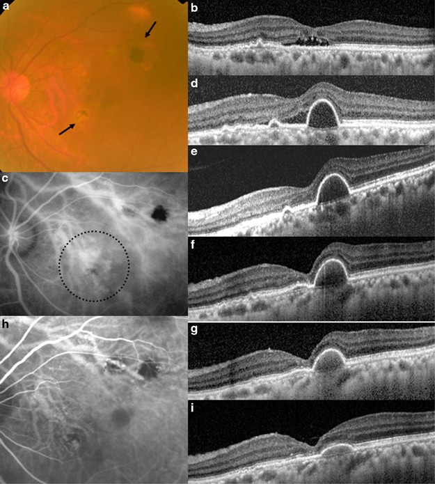 pigment epithelial detachment