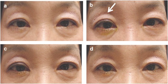Incidence Of Deepening Of The Upper Eyelid Sulcus In Prostaglandin