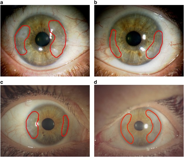 corneal degeneration treatment