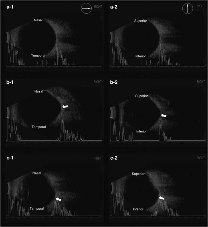 Posterior staphyloma is related to optic disc morphology and the location  of visual field defect in normal tension glaucoma patients with myopia | Eye