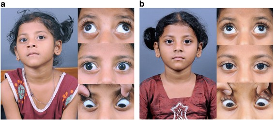 Pattern Strabismus And Torsion Needs Special Surgical Attention Eye