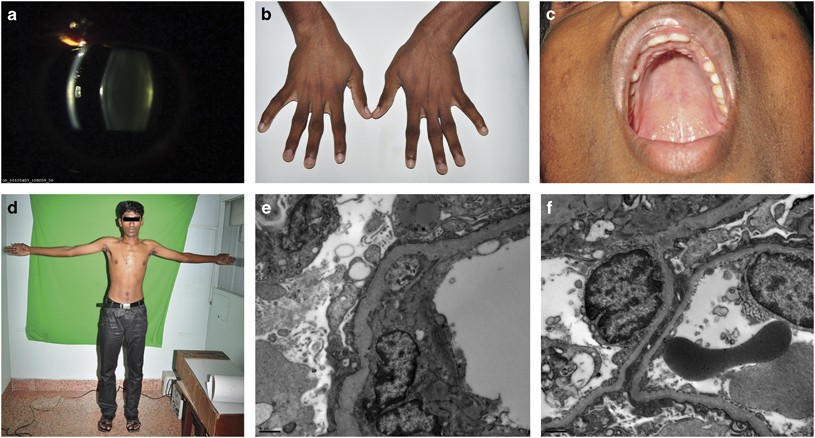 Alport syndrome with phenotypic marfanoid habitus: atypical case series |  Eye