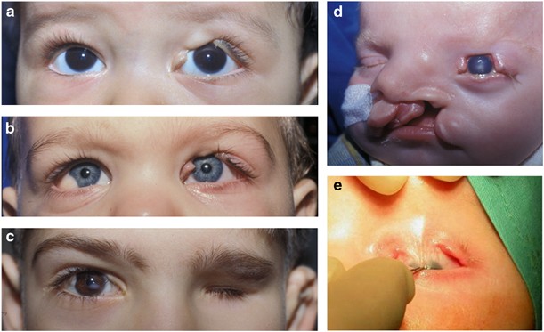 The incidence, embryology, and oculofacial abnormalities associated with  eyelid colobomas | Eye