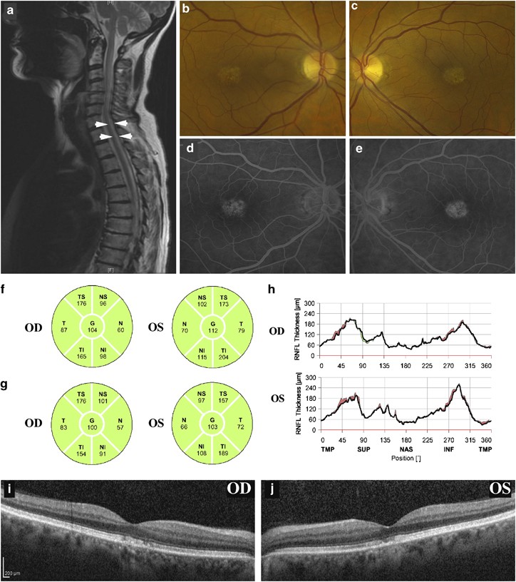 A woman with bilateral maculopathy and acquired vitamin B12 deficiency | Eye