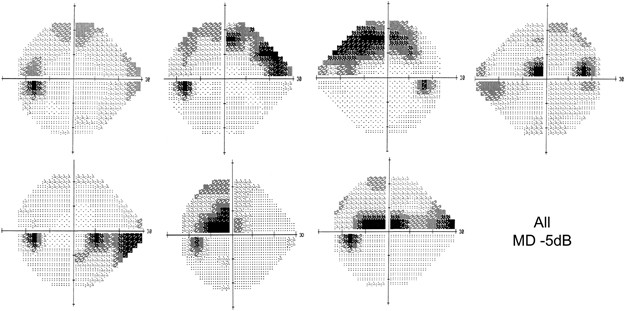 Visual Field Defects Chart