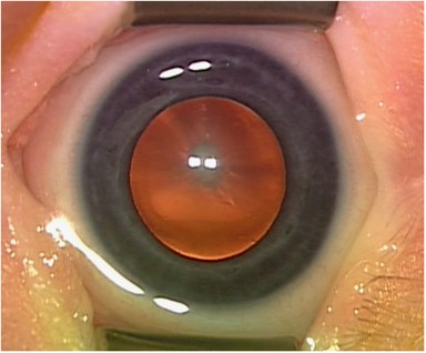 Associated systemic and ocular disorders in patients with congenital  unilateral cataracts: the Infant Aphakia Treatment Study experience | Eye