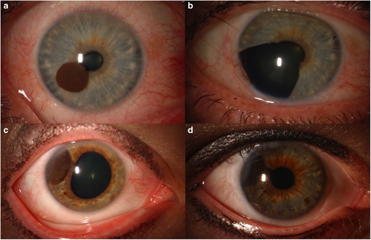 Uveal melanoma: relatively rare but deadly cancer | Eye