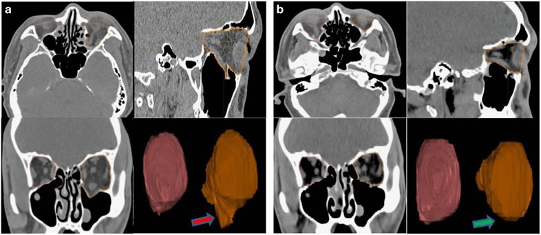 Orbital Volume Restoration Rate After Orbital Fracture A Ct