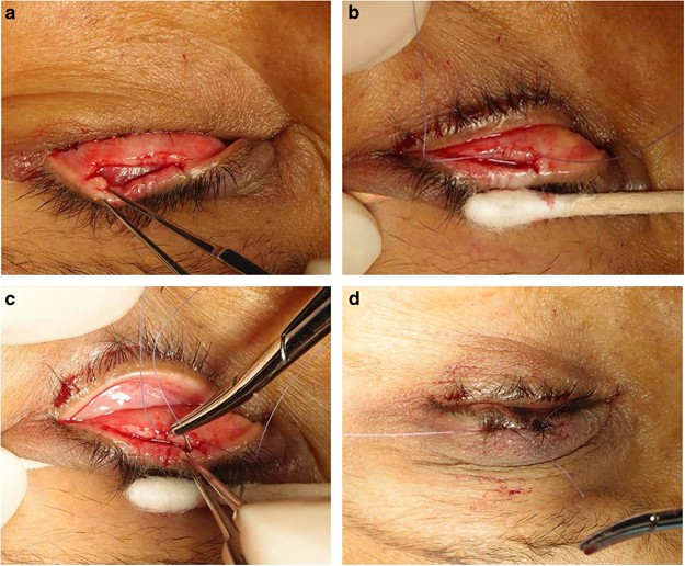 what is entropion surgery