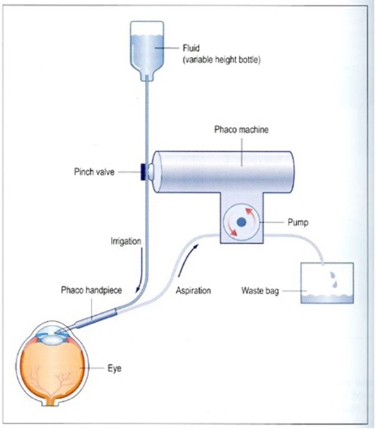 Fluidics And Rheology In Phaco Surgery What Matters And - 