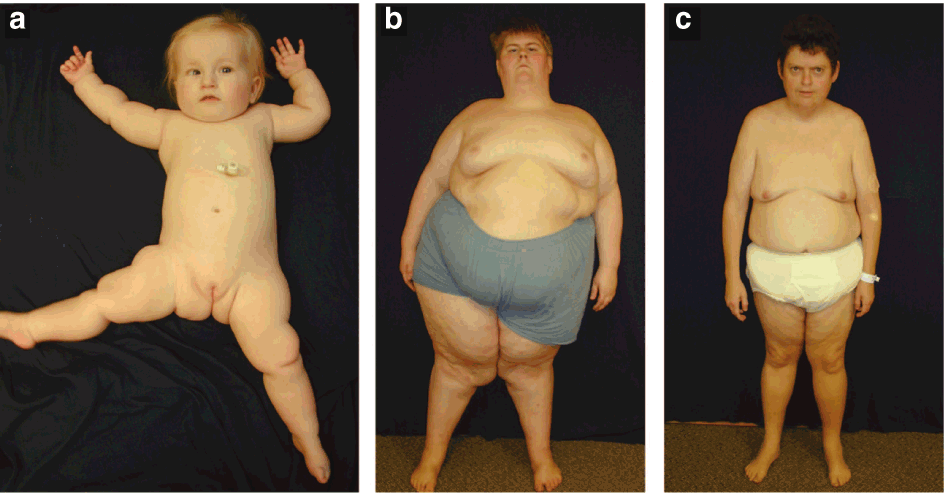 Small hands characteristic of Prader-Willi syndrome.