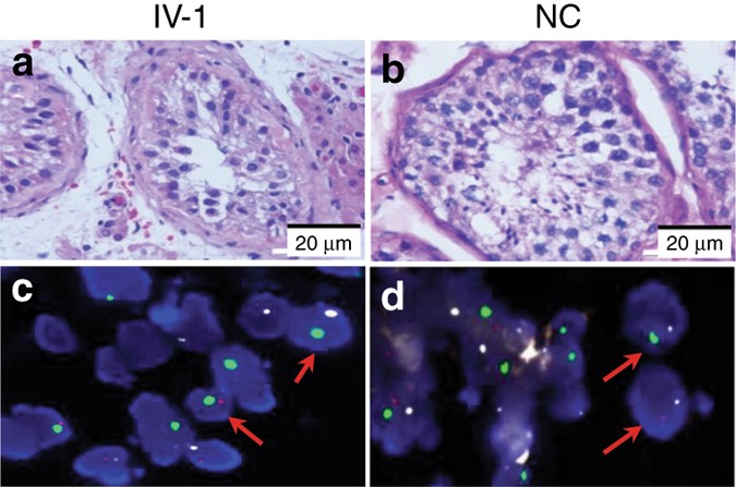 Figure 2: Analysis of testis biopsy samples from IV-1 (family 1) and a normal control.