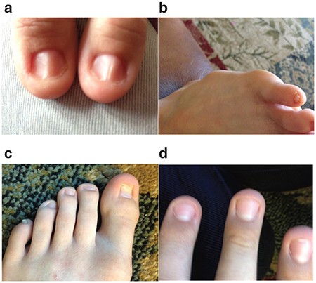 Mutation of WIF1: a potential novel cause of a Nail-Patella-like disorder | Genetics in Medicine Mutation of WIF1: a potential novel cause of a Nail-Patella-like disorder | Genetics in Medicine