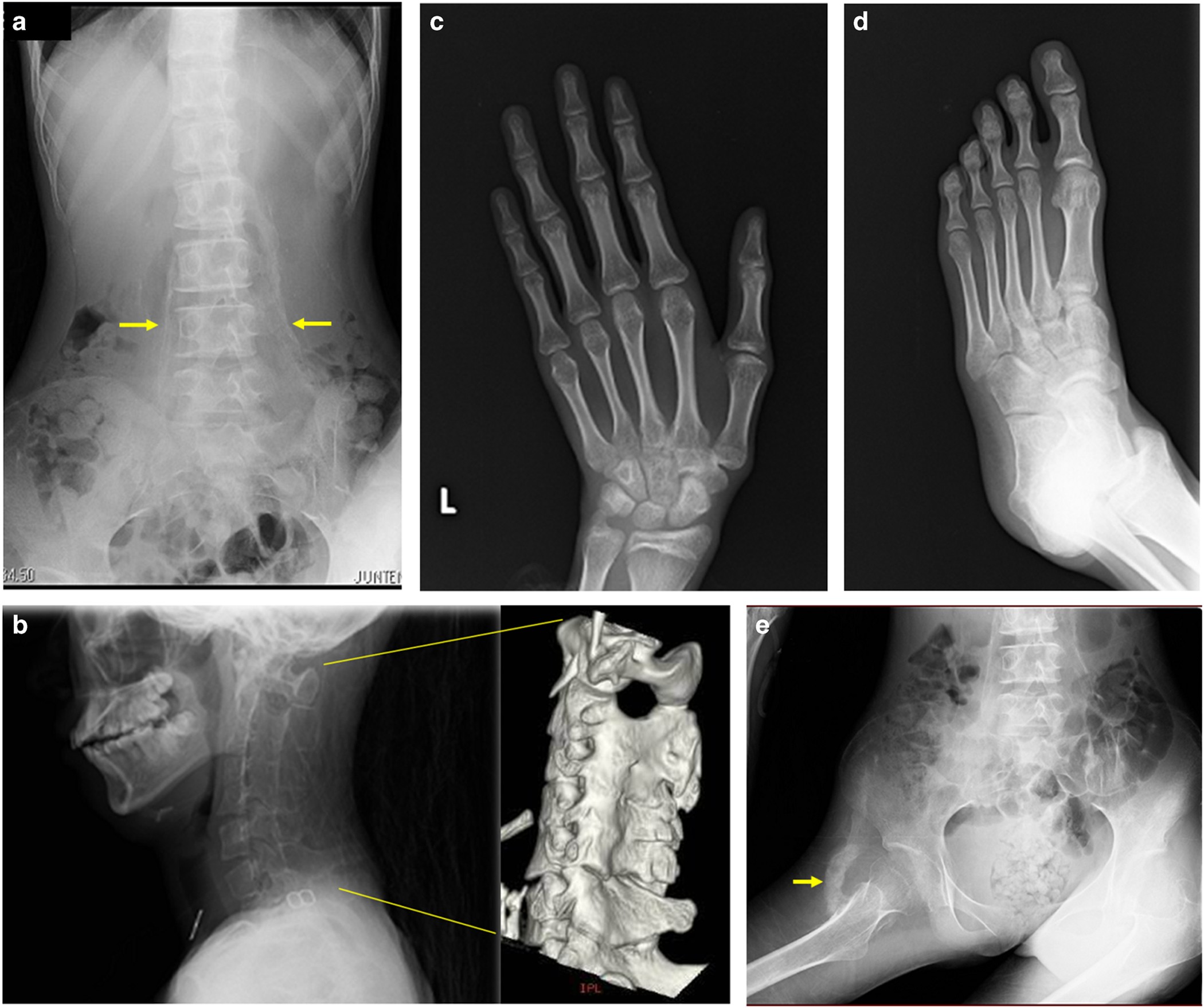 Phenotypic differences of patients with fibrodysplasia ossificans  progressive due to p.Arg258Ser variants of ACVR1 | Human Genome Variation
